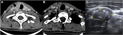 Role of computed tomography in the evaluation of regional metastasis in well-differentiated thyroid cancer